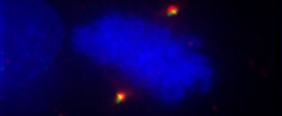 Multipolar melanoma cells stained for centrosomes (gamma-tubulin in red, centrin in green) and DNA (DAPI in blue).