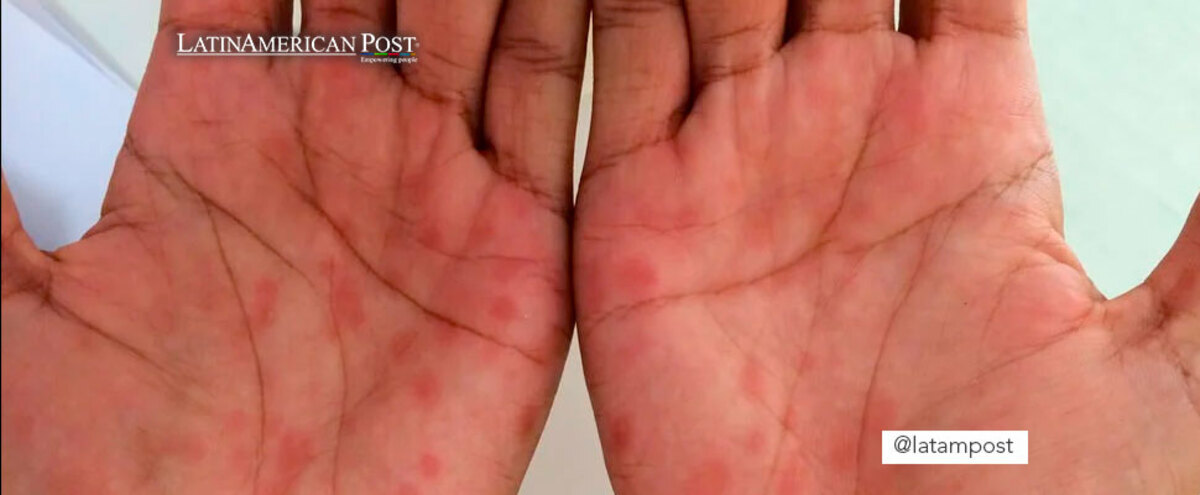 Hands showing the symptoms of syphilis