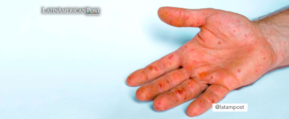 Hand showing monkeypox welts