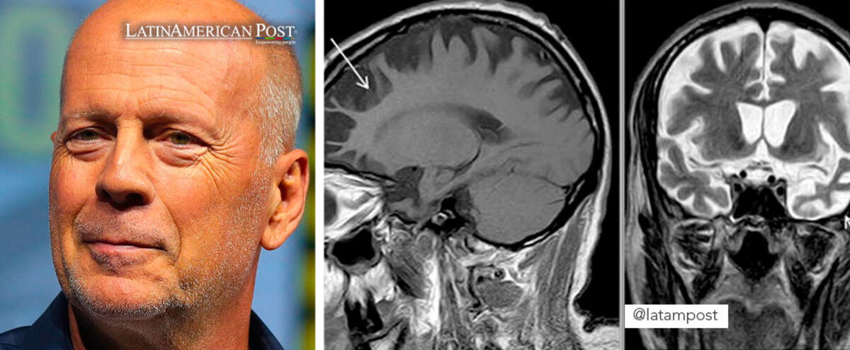 Bruce Willis and medical studies of the brain